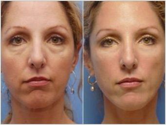 Miofascial масаж на лицето: характеристики и правила