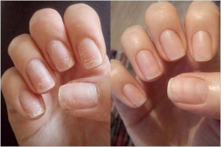 Как да възстановите ноктите си след разширение?