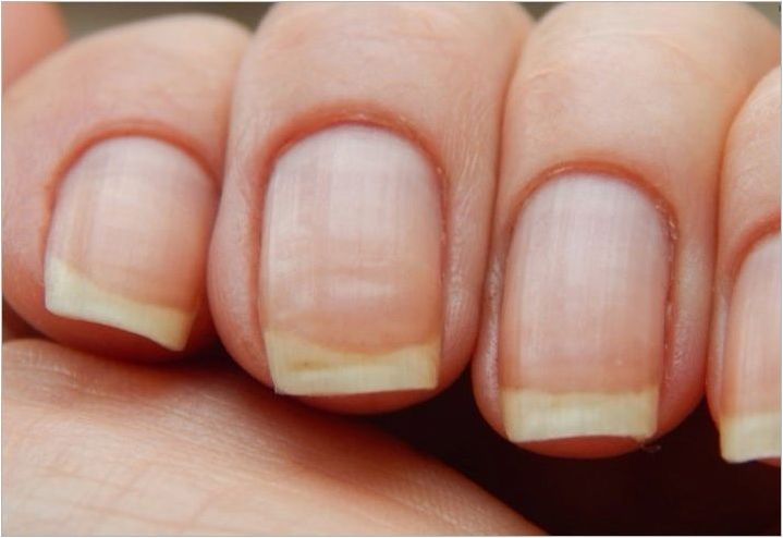Какви са здравословните нокти и как външният им вид е свързан със здравето?