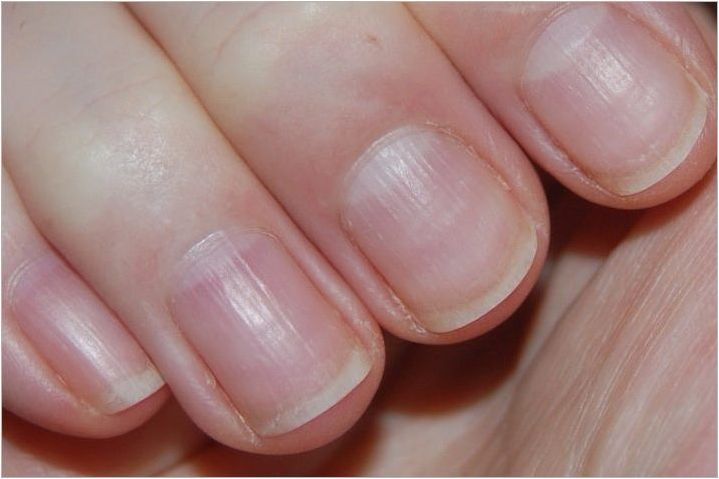 Какви са здравословните нокти и как външният им вид е свързан със здравето?