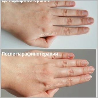 Студена парафинова терапия за ръце: какво е и как да се направи?